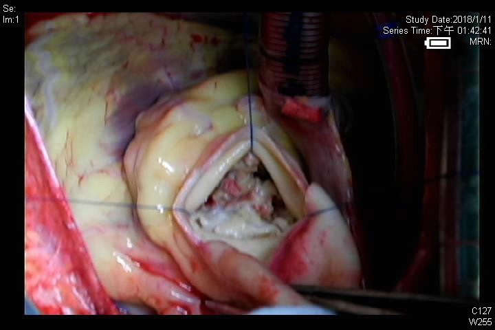 常見的心臟手術：主動脈瓣更換術