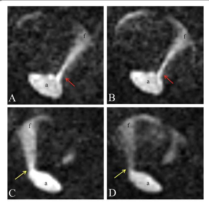 主動脈診斷技術更新 4D phase MRI for aortic position 刊登於 BMC Medical Imaging