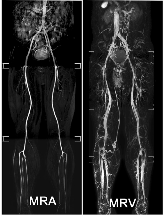 新診斷技術研發 TRANCE MR FOR LEG VENOUS DISEASE: 原著論文發表於BMC MEDICAL IMAGING
