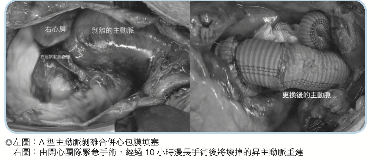 主動脈剝離－長庚醫訊教育文章