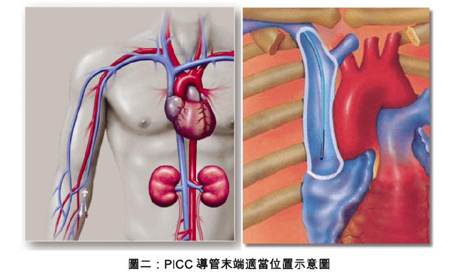 週邊置入中心靜脈導管 (PICC)簡介