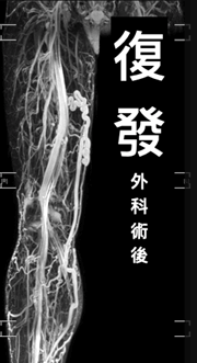 靜脈曲張治療