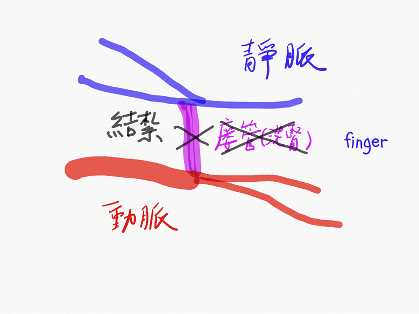 洗腎手臂