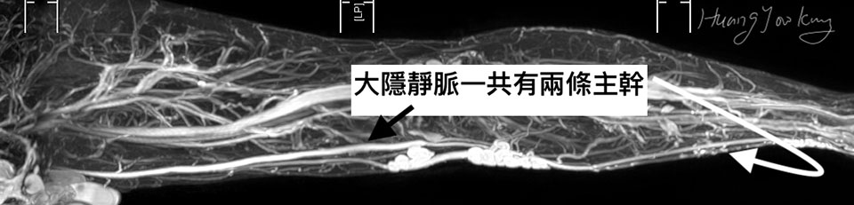 靜脈曲張治療