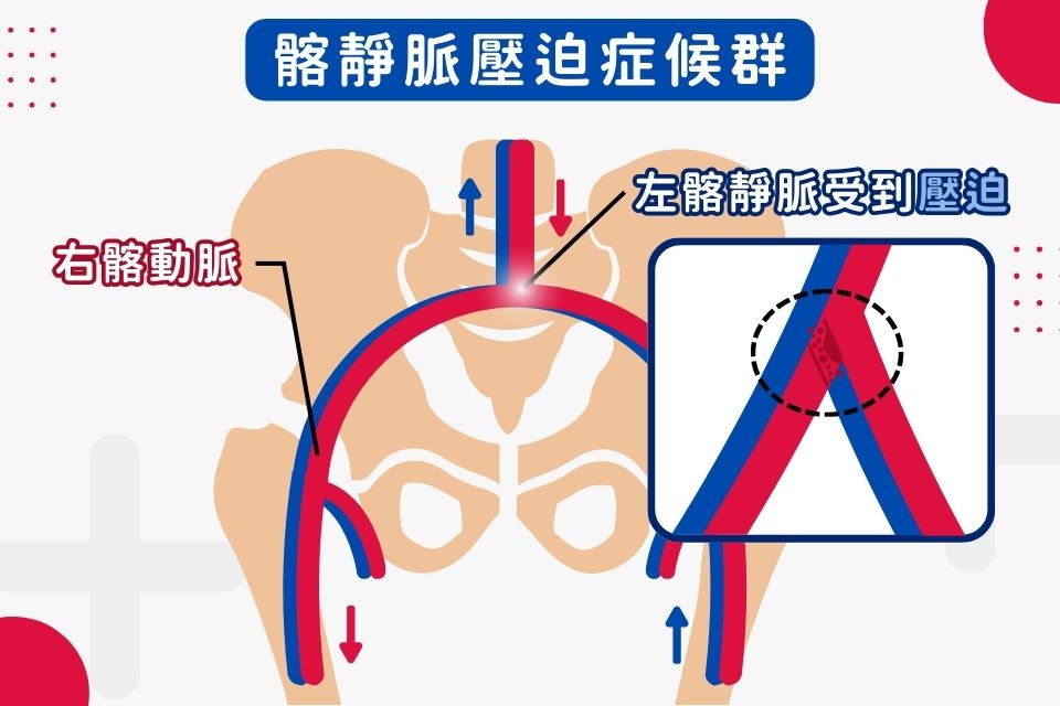 髂靜脈壓迫症