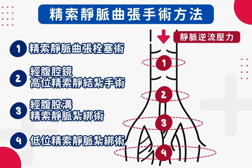 精索靜脈曲張手術治療