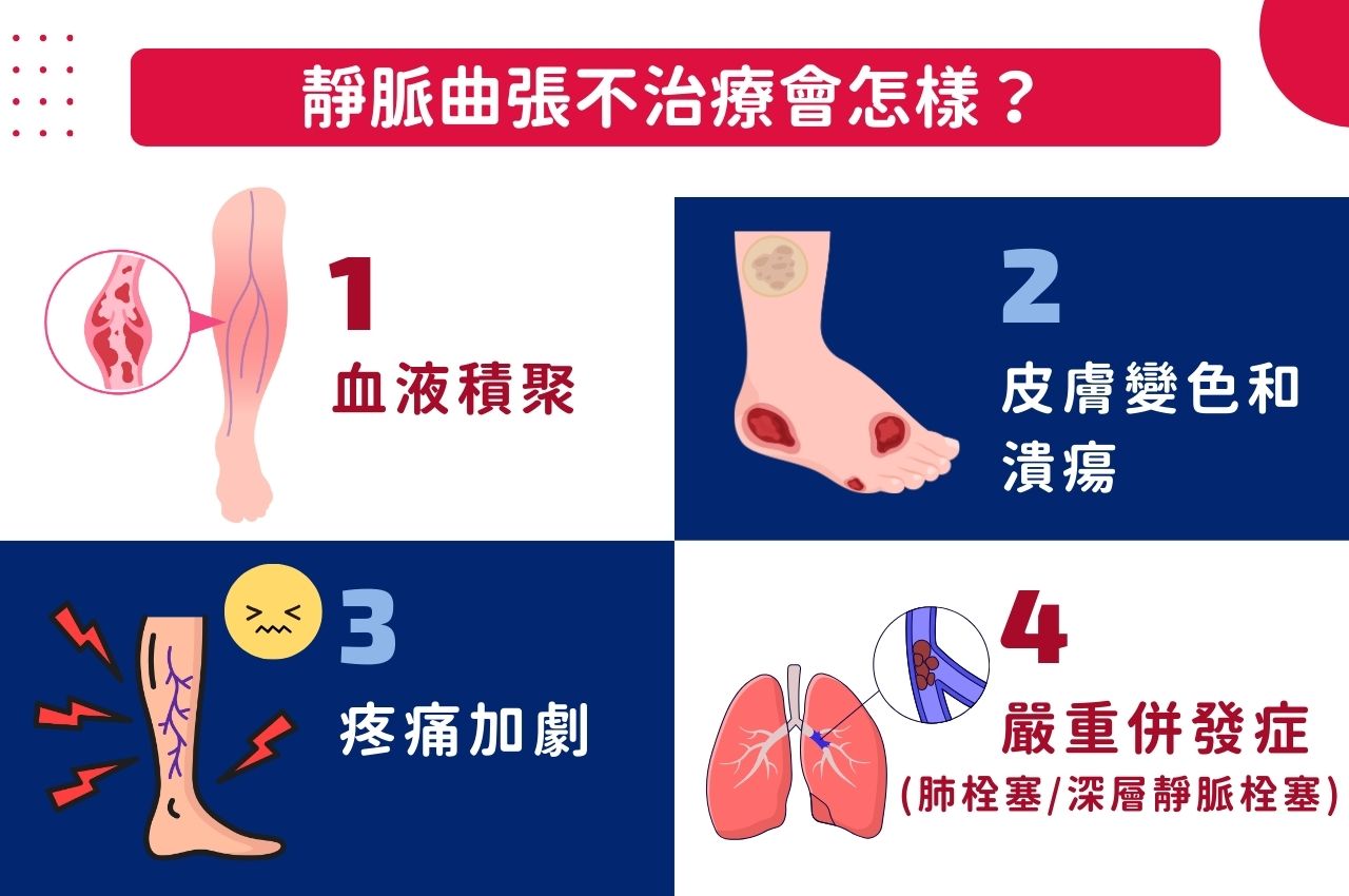 靜脈曲張不治療會怎樣？