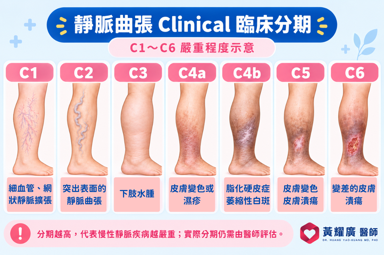 靜脈曲張嚴重程度分級圖