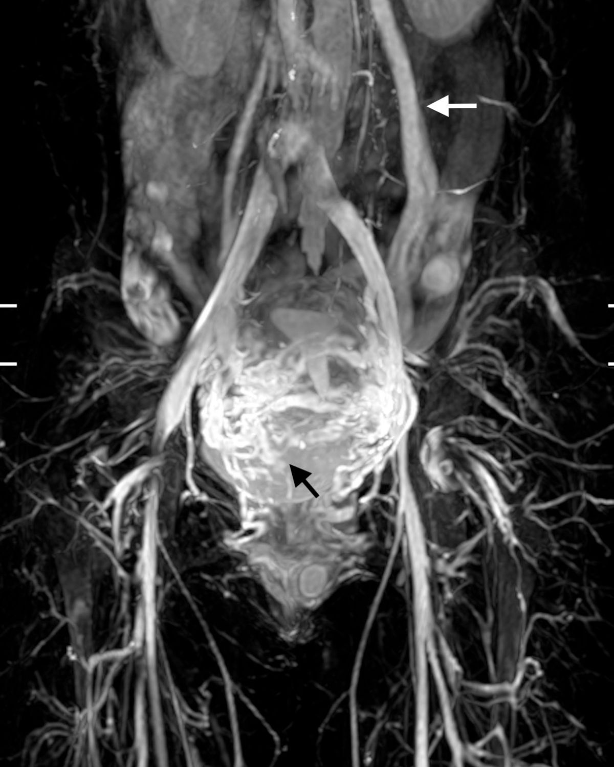骨盆腔充血狀態