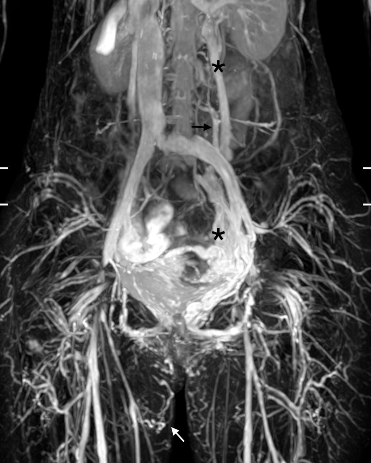 過多的骨盆腔血流