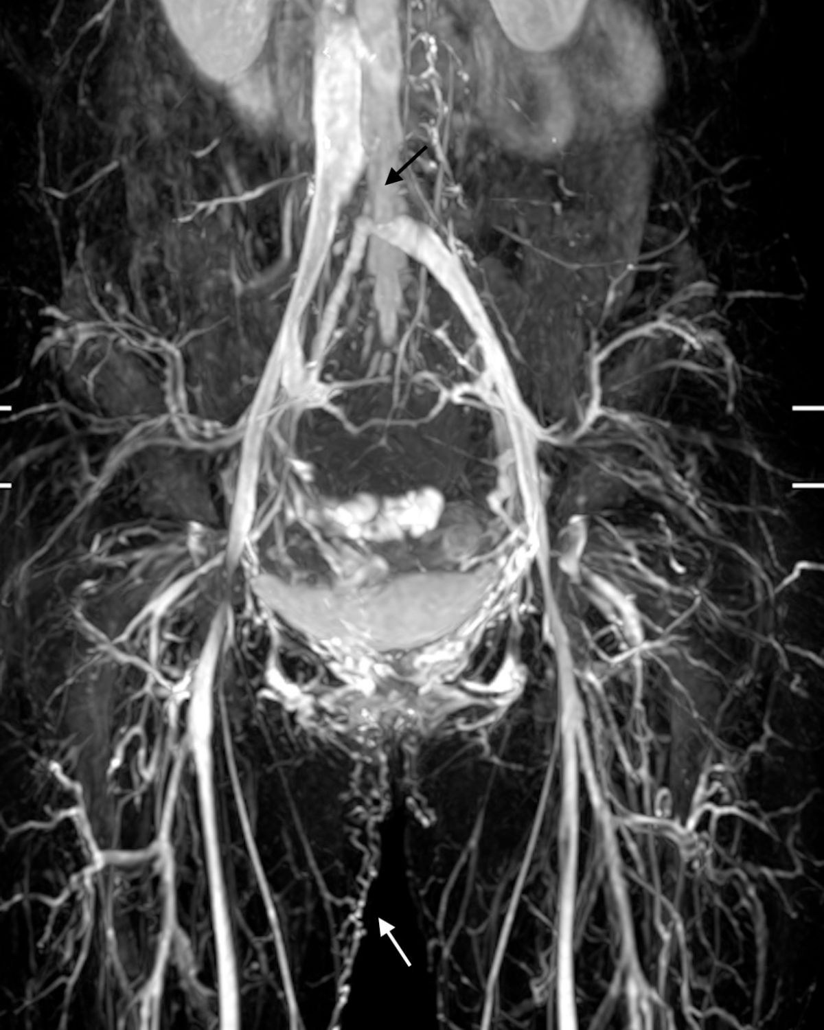 過多的骨盆腔血流