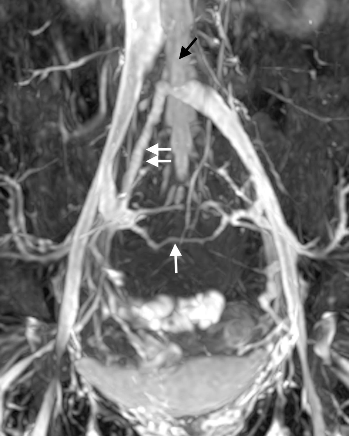 過多的骨盆腔血流