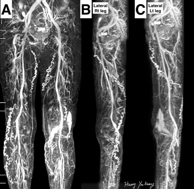 骨盆充合併骨盆腔滲漏及雙足靜脈曲張案例