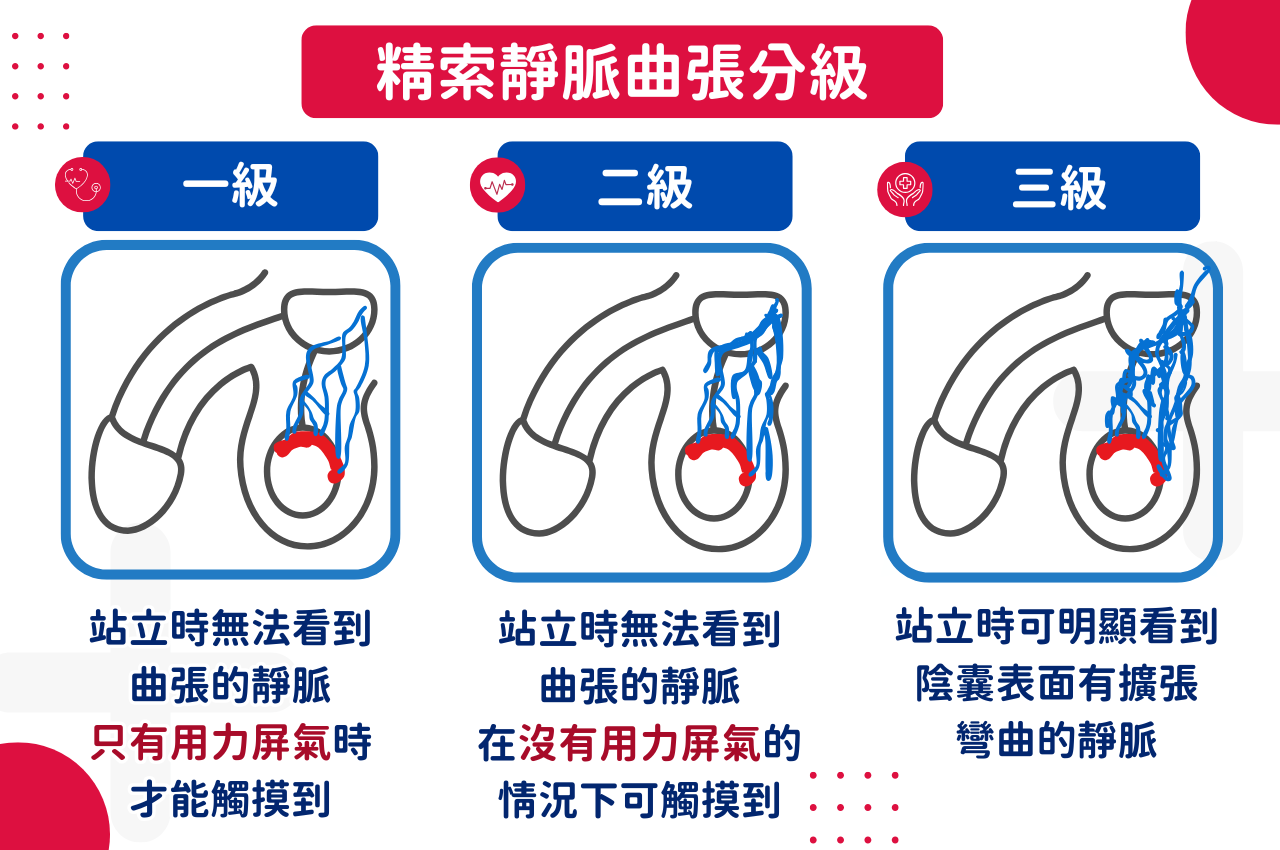 精索靜脈曲張分級狀況一覽