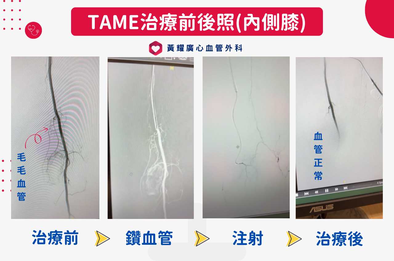 神奇的「消痛塞子」：什麼是T.A.M.E.